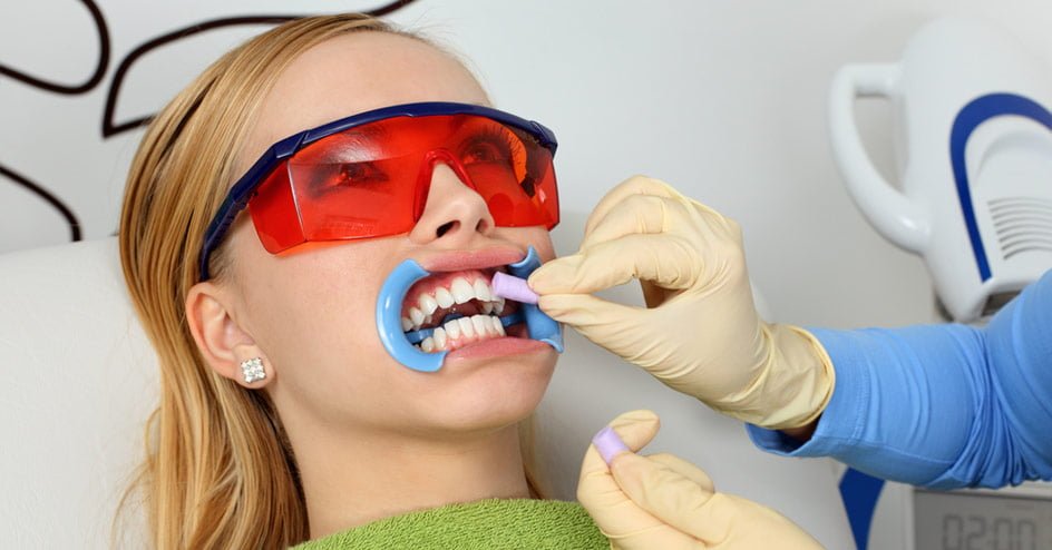 Tannbleking hos tannlege